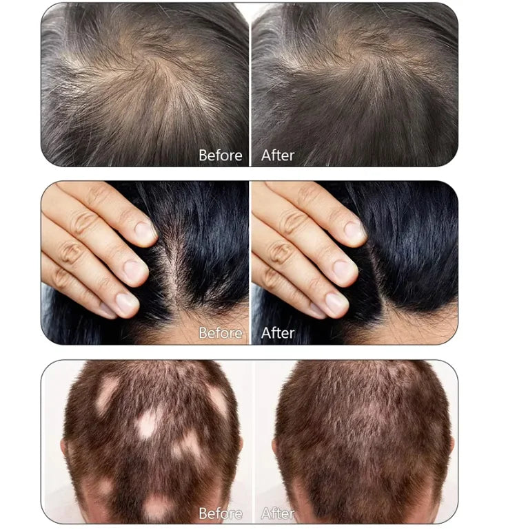 Homeuse 650nm Diode Laser Hair Growth Machine for Hair Growth & Regrowth Anti-Hairloss Treatments for Scalp with 262 Laser Lamps