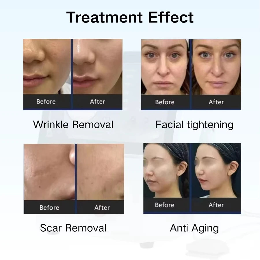 Top-Quality Professional Thermal Micropin Device for Skin Tightening & Face Lifting Facial Wrinkle Removal Machine
