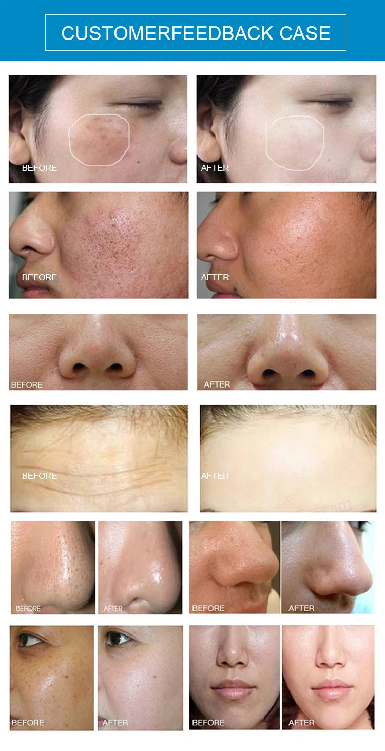 5 in 1 Desktop Hydro bubble Water Dermabrasion face cleanning BIO Microcurrent face care machine